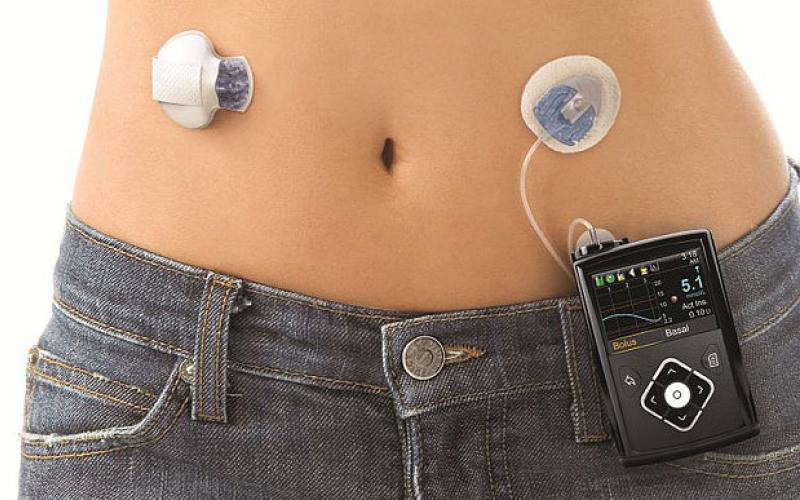 Έφτιαξαν τεχνητό πάγκρεας που μιμείται το ανθρώπινο – Σπουδαία νέα για τους διαβητικούς