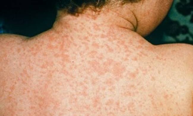 Επανεμφανίστηκε η ιλαρά στην Ελλάδα – Μεγάλη ανησυχία