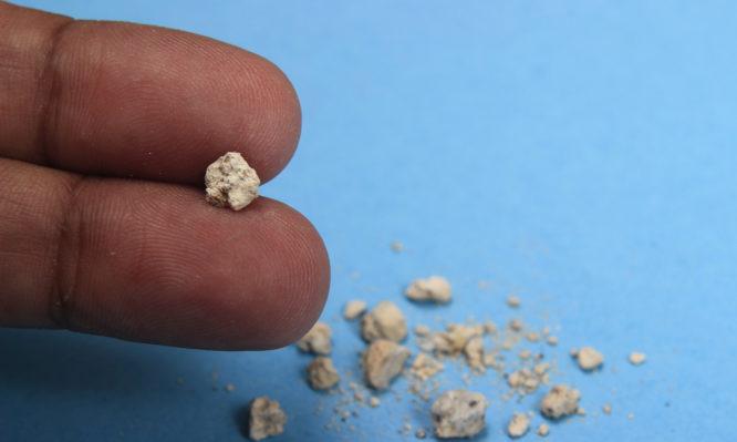 Πώς θα καταλάβετε αν έχετε πέτρες στα νεφρά