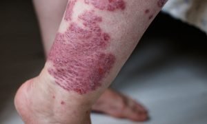 Έκζεμα: 5 εναλλακτικές θεραπείες αντιμετώπισης (εικόνες)