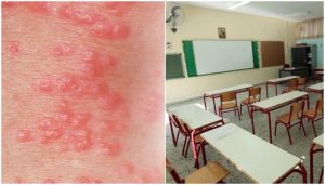 Απίστευτο!Έβαλαν λουκέτο σε σχολείο λόγω… ψώρας – Τι πρέπει να γνωρίζουν όλοι οι γονείς