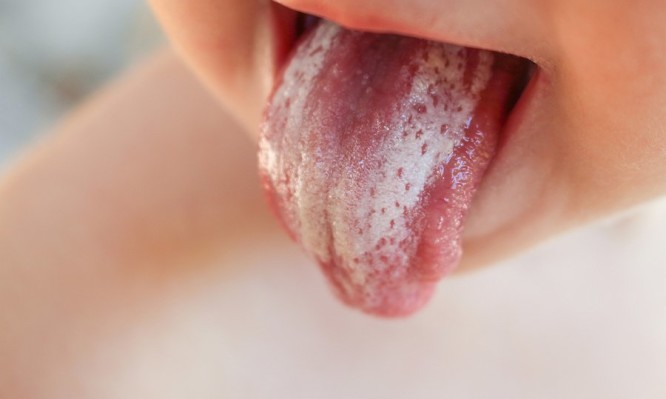 Τι μπορεί να σημαίνει η λευκή γλώσσα στο παιδί – Μην το αμελήσετε