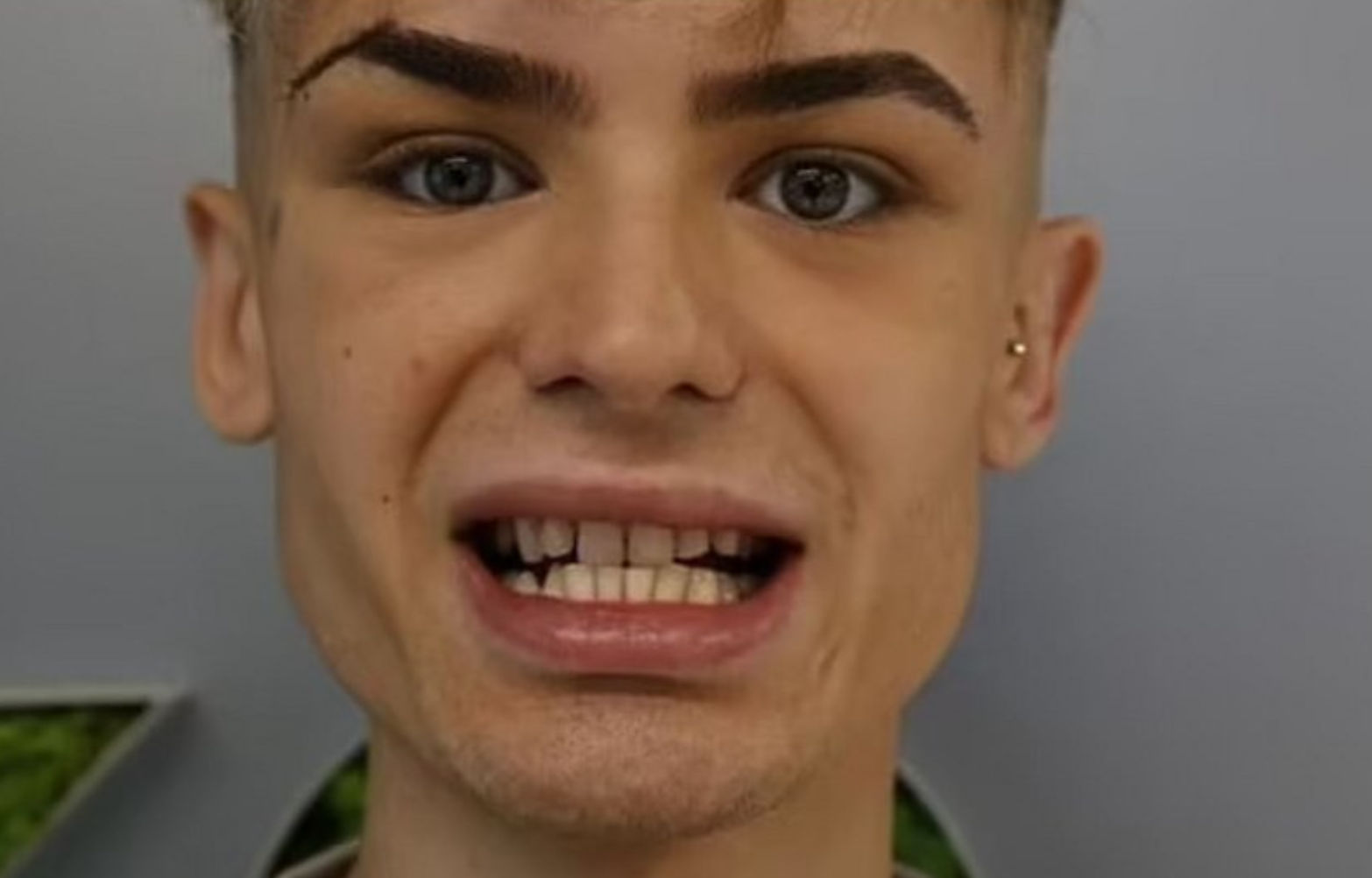 Πλήρωσε 3.500 ευρώ για τα δόντια του και τώρα μοιάζει με… καρχαρία