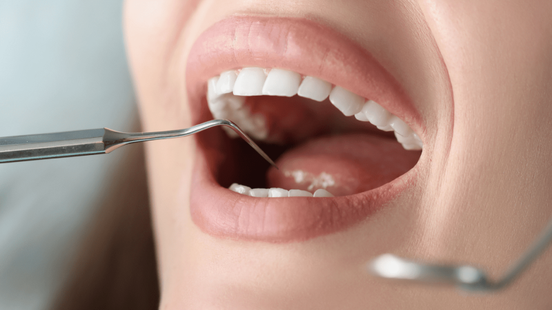 Καρκίνος στο στόμα: To προειδοποιητικά σημάδια- συμπτώματα «καμπανάκι»