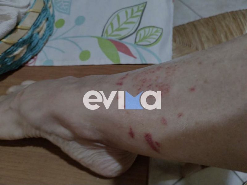 Εύβοια: Τρομακτικό τσίμπημα μωβ μέδουσας στο πόδι – Νέα εικόνα Εύβοια: Τρομακτικό τσίμπημα μωβ μέδουσας στο πόδι – Νέα εικόνα