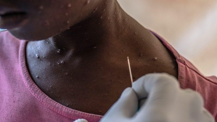 Συναγερμός μετά τον εντοπισμό κρούσματος mpox Συναγερμός μετά τον εντοπισμό κρούσματος mpox