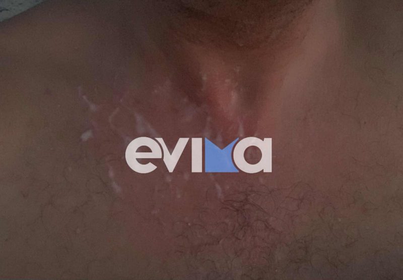 Οι επικίνδυνες επισκέπτριες της Εύβοια ξανα… τσιμπούν: Νέα επίθεση μωβ μέδουσας- Πού έγινε Οι επικίνδυνες επισκέπτριες της Εύβοια ξανα… τσιμπούν: Νέα επίθεση μωβ μέδουσας- Πού έγινε